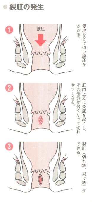 裂肛の発生