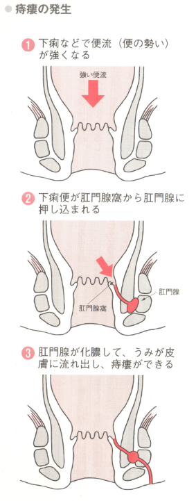 痔瘻の発生