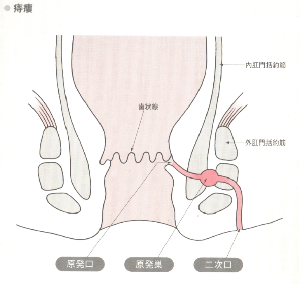 痔瘻