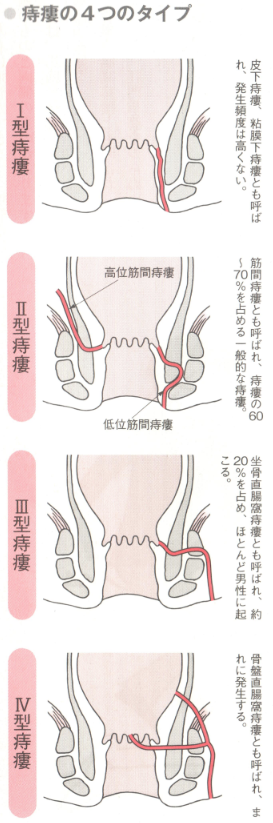 痔瘻の4つのタイプ