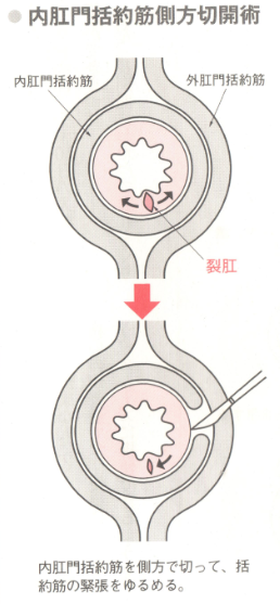 内肛門括約筋側方切開術
