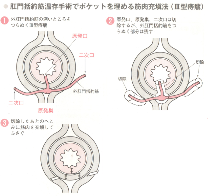 肛門括約筋温存手術筋肉充填法（Ⅲ型痔瘻）